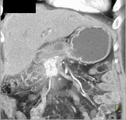 Cavernous Transformation of the Portal Vein With Perfusion Changes in the Liver - CTisus CT Scan