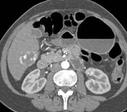 Hemangioma in Various Renderings - CTisus CT Scan