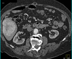 Metastatic Islet Cell Tumor - CTisus CT Scan