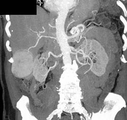 Metastatic Islet Cell Tumor - CTisus CT Scan