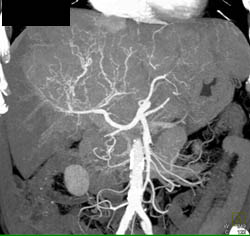 Hepatoma With Neovascularity in Multiple Phases and Displays - CTisus CT Scan