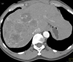 Hepatoma - CTisus CT Scan