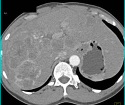 Hepatoma - CTisus CT Scan