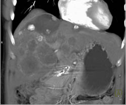 Hepatoma - CTisus CT Scan