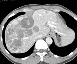 Metastatic Colon Cancer - CTisus CT Scan