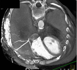 Collaterals Due to SVC Occlusion - CTisus CT Scan