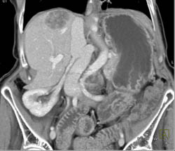 Hepatoma - CTisus CT Scan