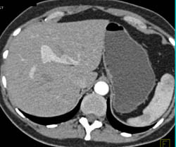 Portal Vein (PV)-hepatic Vein Shunt - CTisus CT Scan