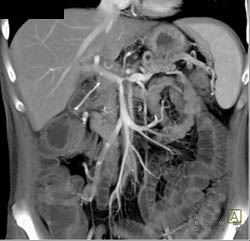 Encased PV/SMV/splenic Vein Due to Pancreatic Cancer - CTisus CT Scan