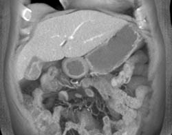 Gallbladder Cancer - Early - CTisus CT Scan