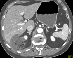 Hepatic Trauma S/P Radiofrequency Ablation (RFA) of Renal Mass - CTisus CT Scan