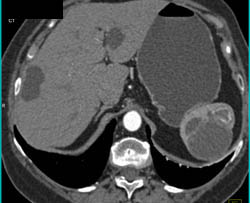 Liver Cysts and Splenic Cysts - CTisus CT Scan