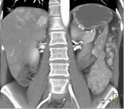 Carcinomatosis and Vascular Liver Metastases - CTisus CT Scan