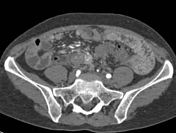 Carcinoid Tumor With Metastases - CTisus CT Scan