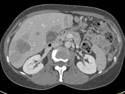 Carcinomatosis - CTisus CT Scan