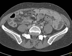 Carcinomatosis - CTisus CT Scan