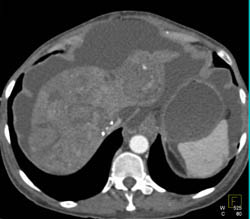 Multiple Vascular Lesions - CTisus CT Scan