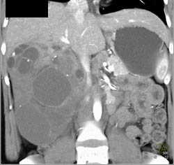 Biliary Cystadenocarcinoma - CTisus CT Scan