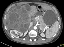 Biliary Cystadenocarcinoma - CTisus CT Scan