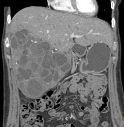 Biliary Cystadenocarcinoma - CTisus CT Scan