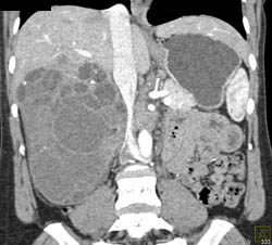 Biliary Cystadenocarcinoma - CTisus CT Scan