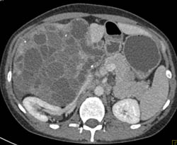 Biliary Cystadenocarcinoma - CTisus CT Scan