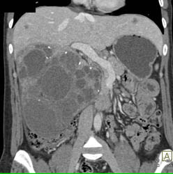 Biliary Cystadenocarcinoma - CTisus CT Scan