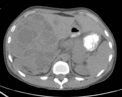 Biliary Cystadenocarcinoma - CTisus CT Scan