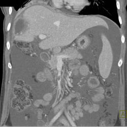 Post Cryotherapy Changes - CTisus CT Scan