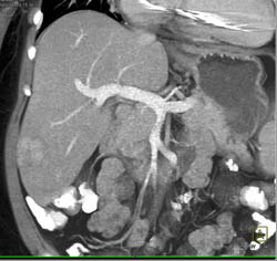 Focal Nodular Hyperplasia (FNH)- Atypical - CTisus CT Scan