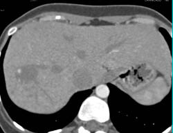 Hemangioma - CTisus CT Scan