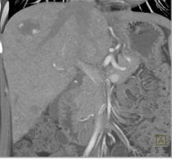 Hemangioma - CTisus CT Scan