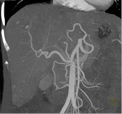 Hemangioma - CTisus CT Scan