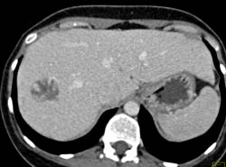 Hemangioma - CTisus CT Scan