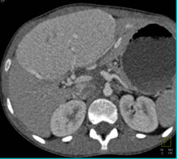 Focal Nodular Hyperplasia (FNH)- Huge in Child - CTisus CT Scan