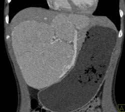 Large Focal Nodular Hyperplasia (FNH) in Child - CTisus CT Scan