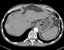 Hepatoma in A Cirrhotic Liver - CTisus CT Scan