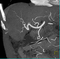 Hepatoma in A Cirrhotic Liver - CTisus CT Scan