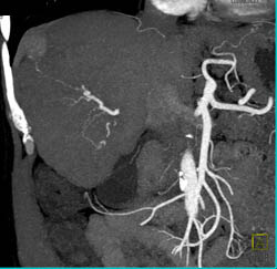 Hepatoma in A Cirrhotic Liver - CTisus CT Scan