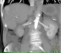 Hepatoma in A Cirrhotic Liver - CTisus CT Scan