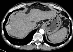 Hepatoma in A Cirrhotic Liver - CTisus CT Scan