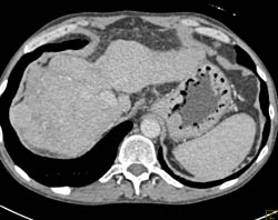 Hepatoma in A Cirrhotic Liver - CTisus CT Scan