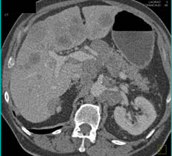 Liver Metastases and Nodes - CTisus CT Scan