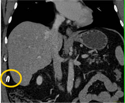 Dropped Clip From Gb Resection - CTisus CT Scan