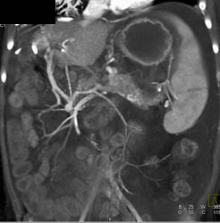 Gastrointestinal (GI) Bleed at Site of Hepatic Surgery - CTisus CT Scan