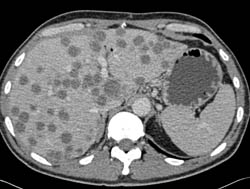 Liver Metastases - CTisus CT Scan