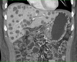 Liver Metastases - CTisus CT Scan