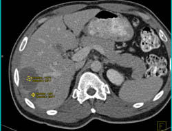 Liver Abscess - CTisus CT Scan