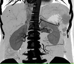 Liver Abscess - CTisus CT Scan