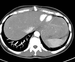 Liver Abscess - CTisus CT Scan